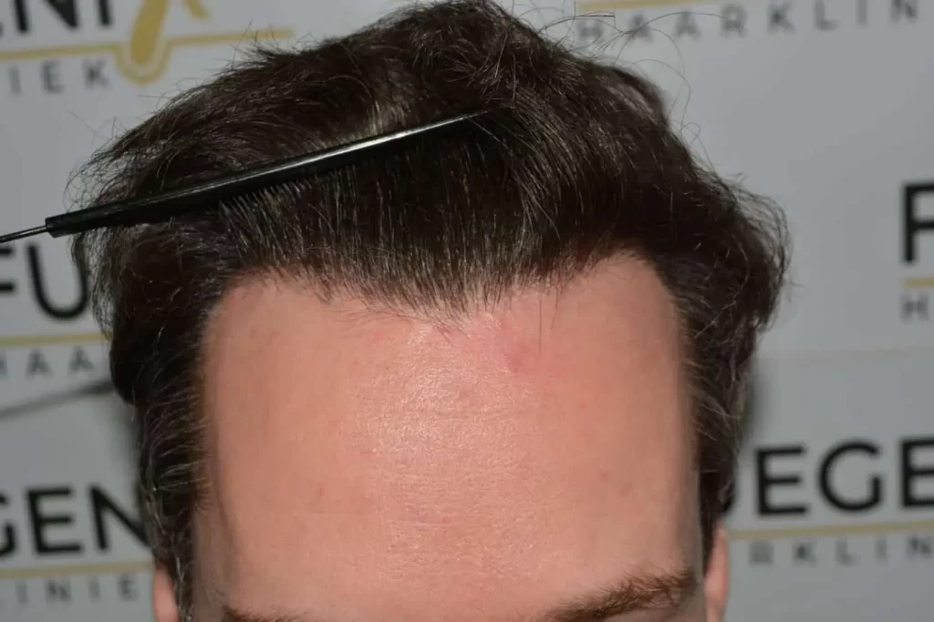 The Henry Cavill Hairline
