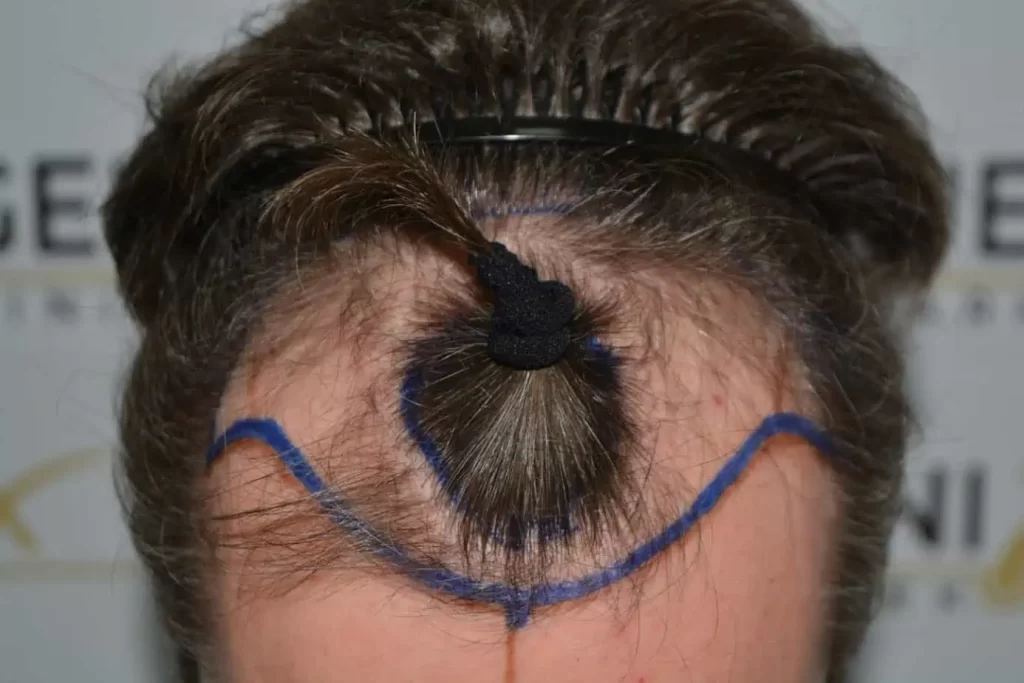 The Henry Cavill Hairline