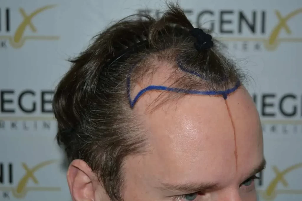 The Henry Cavill Hairline