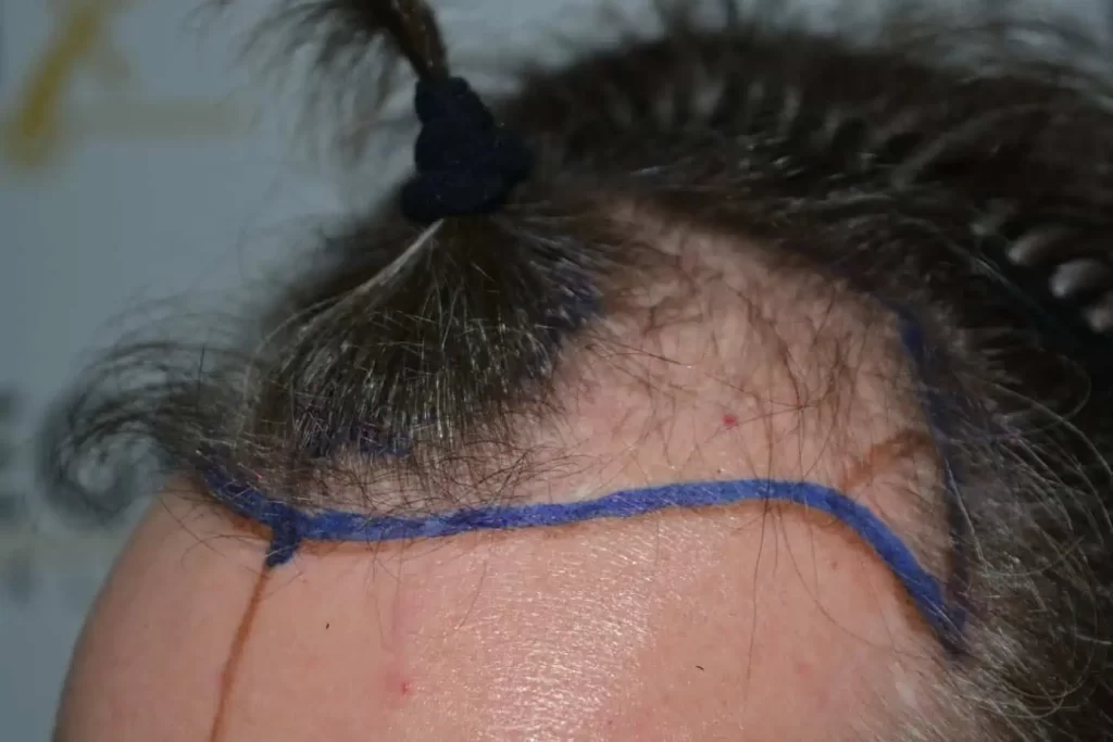 The Henry Cavill Hairline