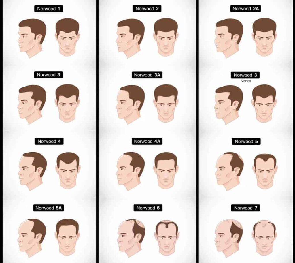 The Norwood scale showing the successive stages of male pattern baldness
